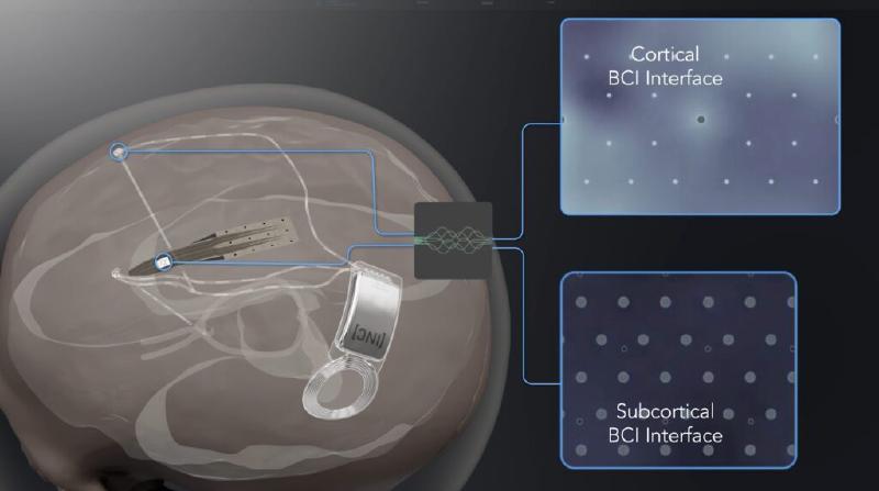 Render of a brain with cortical and subcortical interfaces connected to an implanted neural controller